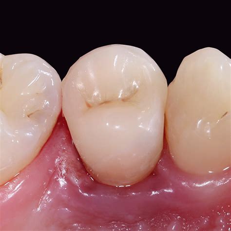 Corona Post Endodonzia Realizzata Con Tecnica CAD CAM In Ceramica