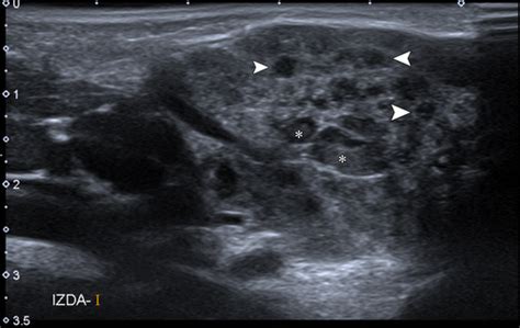 Parotid Gland Tumor Ultrasound