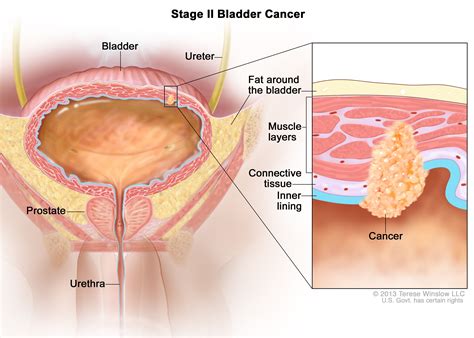 Etapas del cáncer de vejiga Medicina Básica