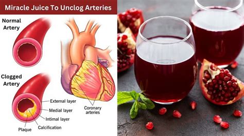 Miracle Drink To Unclog Arteries And Prevent Heart Attack In 2022