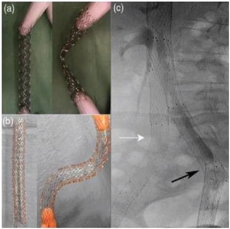 Table 1 From Clinical Outcomes And Overview Of Dedicated Venous Stents For Management Of Chronic