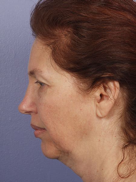 Los Angeles Facelift Before And After Photos Beverly Hills Plastic