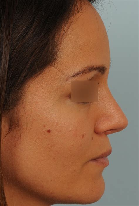 Photos De Rhinoplastie Avec Pointe De Nez Large Avant Et Apr S