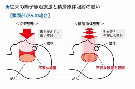 福井県立病院陽子線がん治療センターの特長 福井県ホームページ