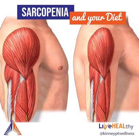 Sarcopenia And Your Diet Kinney Physical Therapy And Wellness