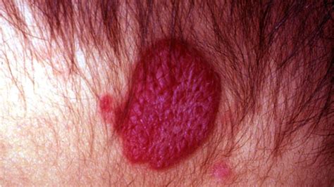 Discolored Skin Patches Pictures Causes And Treatments