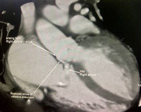 Ruptured Sinus Of Valsalva Ct Sumer S Radiology Blog