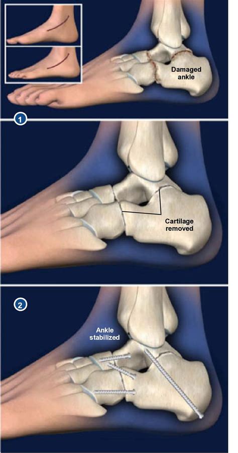 Triple Arthrodesis Orthopaedic Associates Of Riverside Artofit