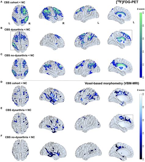 Brain Glucose Metabolism And Brain Atrophy Patterns In Patients With