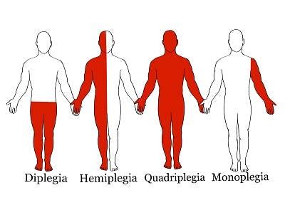 Different Types of Cerebral Palsy: Spastic, Dyskinetic, and More