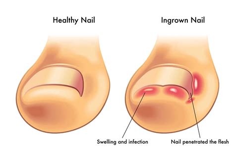 Understanding And Treating Ingrown Toenails Stepping Stone