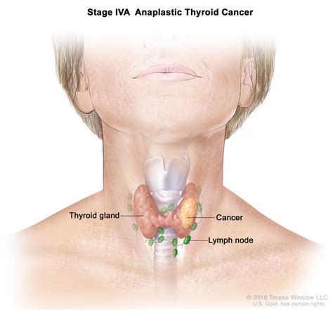 Table Table 4 Definitions Of Tnm Stages For Anaplastic Thyroid