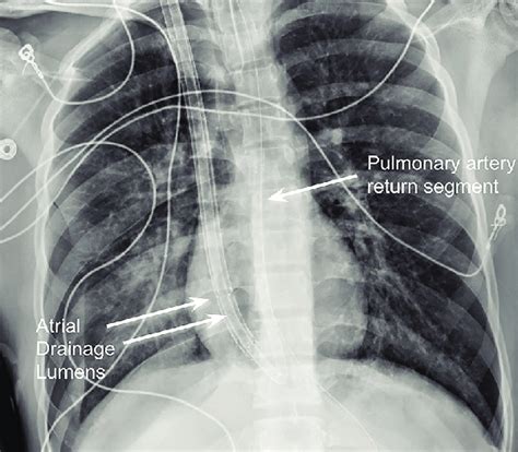 Chest X Ray Performed After Placement Of The Protek Duo Extracorporeal