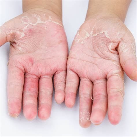 Irritantcontactdermatitis Dermatitis Academy