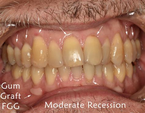 Receding Gums Stages Sarasota Dentistry