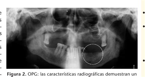 Figure From Osteonecrosis De Los Maxilares Asociada Al Empleo De