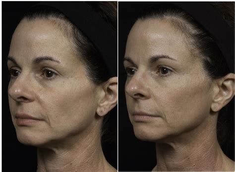 Thermage Before After Photo Gallery Houston Tx Dermsurgery