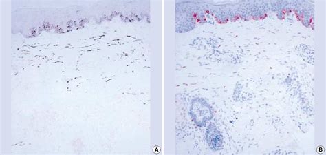 Figure 2 From Comparison Of Characteristics Of Acquired Bilateral Nevus