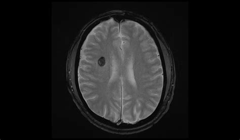 Cavernoma MRI | Radiology Article on Cavernous Hemangioma