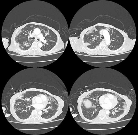 Computed Tomography Scan Images Of Chest Showing Multifocal Air Space