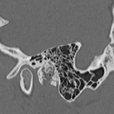 External Auditory Canal Osteoma Image Radiopaedia Org