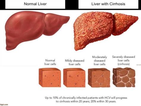 Cirrhosis