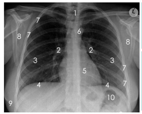 Normal Chest X Ray Diagram Quizlet