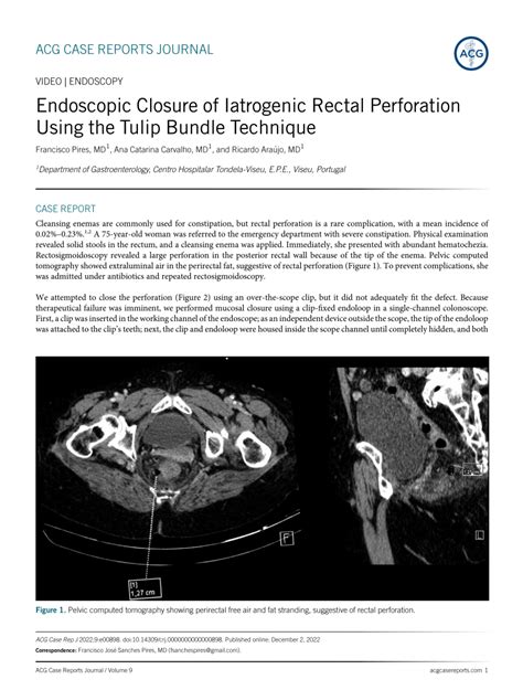 Pdf Endoscopic Closure Of Iatrogenic Rectal Perforation Using The Tulip Bundle Technique