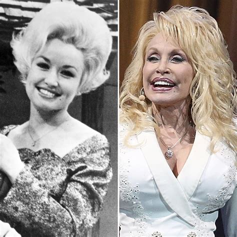 Dolly Parton Plastic Surgery: What Has She Gotten Done?