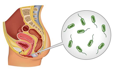 Waginoza Bakteryjna Czym Grozi I Jak J Leczy
