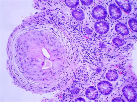 Pathology Of Schistosomiasis Dr Sampurna Roy Md