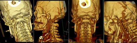 Occipital Dural Arteriovenous Fistula - Radiology Imaging