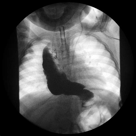 Figure E3 Upper Gastrointestinal Contrast Study At Age 27 Years