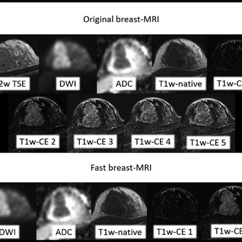 MRI dataset of a 39-yearold breast cancer patient with a T2 ts breast ...