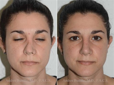 Revision Rhinoplasty Miami Perfect Your Nose With Dr Bustillo