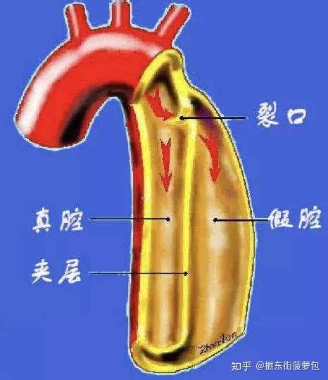 生活中常见急性重症之一 主动脉夹层 知乎