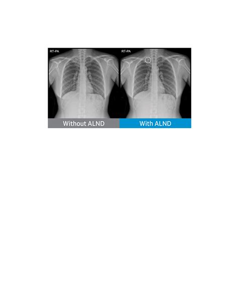 Samsung Receives Fda Clearance For Ai Algorithms That Detect Lung