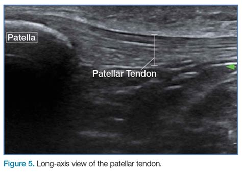 Patellar Tendon Tear Ultrasound