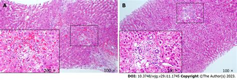 Pathological Results Of Liver Allograft Biopsy A Patient The