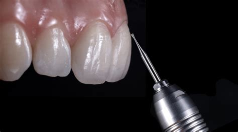 Replicating Individual Tooth Texture In Ceramic Restorations Rezotto