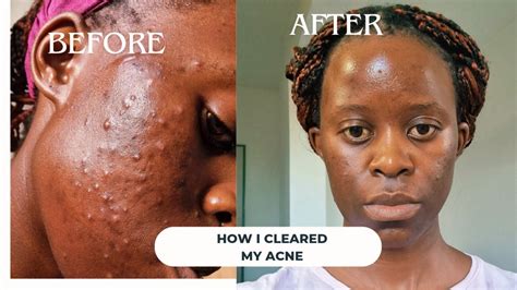 How I Cleared My Acne Products That Changed My Skin Youtube