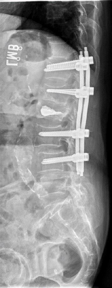 Plain Lateral Radiography Of Lumbar Spine After Operation Plain Film