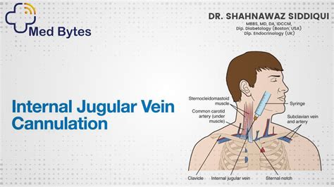 Ijv Cannulation Central Line Youtube