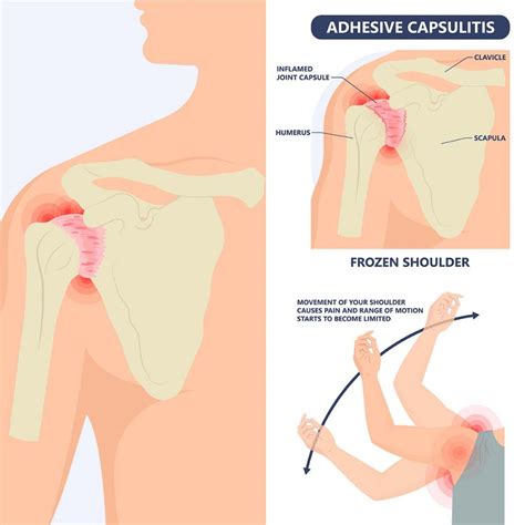 Key Insights About Frozen Shoulder In 2024 Vejthani