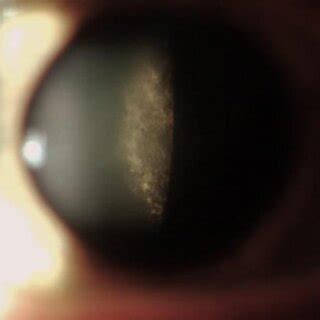 Picture of a typical form of cornea verticillate in a patient affected. | Download Scientific ...