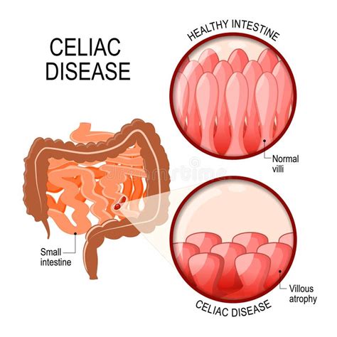 Celiac Disease Small Intestine Lining Damage Stock Vector