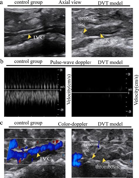 Monitoring Of The Thrombus Formation Of The Inferior Vena Cava Ivc