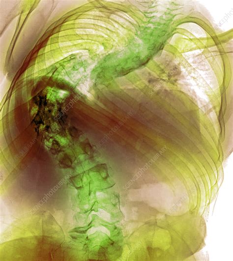 Scoliosis, X-ray - Stock Image - F041/8384 - Science Photo Library