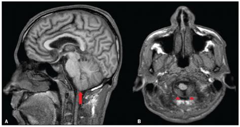 Radiologia Brasileira Hipertens O Intracraniana Idiop Tica Um Guia