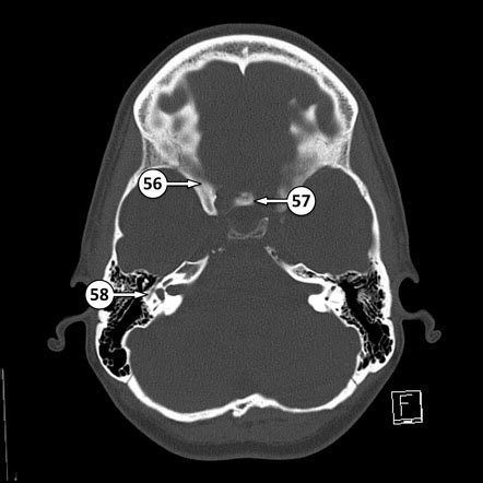 Tuberculum sellae | Radiology Reference Article | Radiopaedia.org